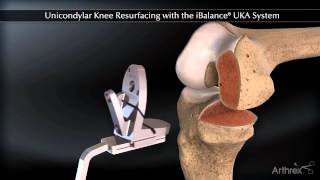 Partial Knee Replacement [upl. by Rudyard69]