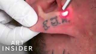 How Tattoo Removal Works [upl. by Araccat]