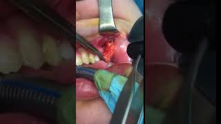 Buccal Fat Removal Surgery  Bichectomy by Dr Angel Enchev MD PhD [upl. by Urial546]