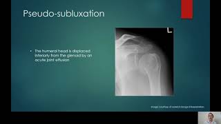 Shoulder xray interpretation [upl. by Avery229]