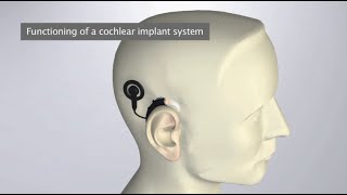 How does a Cochlear Implant work [upl. by Leibrag58]