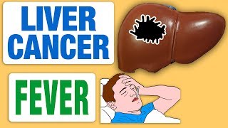 Liver Cancer and Fever [upl. by Camile]