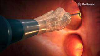 Detroit Medical Center Cryo Ablation Treatment for Atrial Fibrillation [upl. by Jankell]