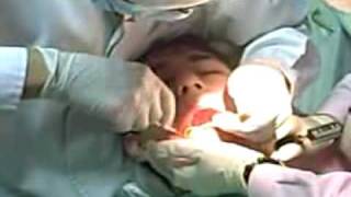 Dentistry Horrors Wisdom tooth procedure full [upl. by Nylrats]