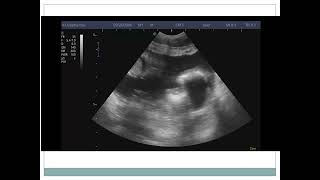 CASE 6 purulent peritonitis due to perforated appendicitis [upl. by Lukash492]