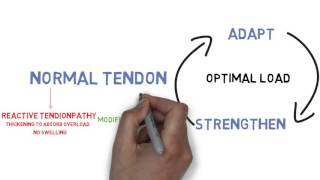 The Tendinopathy Continuum [upl. by Anelram]