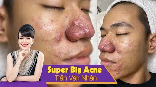 Remove super bis acne Điều trị mụn hiệu quả số 1 TPHCM Hiền Vân Spa  Trần Văn Nhân 538 [upl. by Erdnaek]