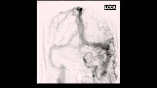 Endovascular treatment of complex dural arteriovenous fistula using the dualmicrocatheter technique [upl. by Aenea]