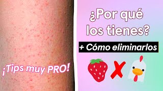 Granitos en BRAZOS y PIERNAS🐔🍓 ¿PORR Y CÓMO QUITARLOS como PRO [upl. by Kumagai]