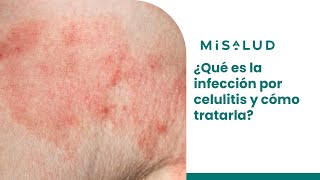 ¿Qué es la infección por celulitis y cómo tratarla  MiSalud [upl. by Okramed872]