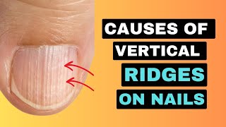 The REAL Causes of VERTICAL RIDGES On Your Nails [upl. by Red354]