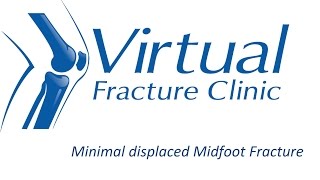 Minimal displaced Midfoot Fractures [upl. by Xenia]