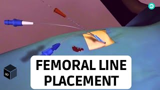 Central Line placement Femoral Vein Medical animation [upl. by Amity]