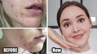 How To Really Get Rid Of Acne amp textureacne scarsskin damage Adult Hormonal Acne [upl. by Milstone443]