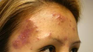 The Acne Practice severe case 5 [upl. by Ahsinrat]