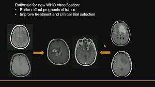 Systemic pathology 15  CNS 1 tumors of CNS  DRSAMEH GHAZY [upl. by Esimaj]