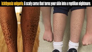 Ichthyosis vulgaris A scaly curse that turns skin into reptilian nightmare [upl. by Anesusa496]