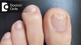 How to manage white spot on toenail  Dr Rajdeep Mysore [upl. by Ahsinut]