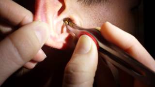 Removing impacted ear wax [upl. by Acirema]