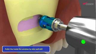 OSSTEM HIOSSEN LASKIT LATERAL APPROACH SINUS KIT [upl. by Eugine]