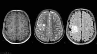 Displasia cortical focal [upl. by Carlos]