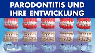 Zahnfleischentzündung Parodontitis und ihre Entwicklung © [upl. by Elocon]