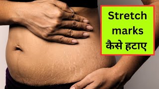 Stretch Marks Removal at Home ll Strech Marks Hone ke Karan ll Mital Chaudhari Ayurveda [upl. by Nais640]