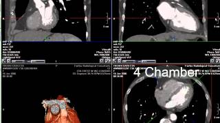 Coronary CT Angiography RCA Stenosis [upl. by Vernier]