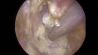 Glue Ear amp ETD in Revealed After Ear Wax Removal  Mr Neel Raithatha THC [upl. by Avlem943]