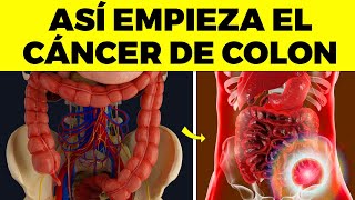 Las 10 PRIMERAS SEÑALES de CÁNCER DE COLON que nunca debes ignorar [upl. by Zetneuq]