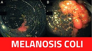 What is Melanosis Coli  Melanosis Coli CausesTreatment LaxativesBiopsyDiagnosis [upl. by Reuben]