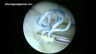 ALL INSIDE REPAIR OF A BUCKET HANDLE TEAR OF THE LATERAL MENISCUS USING THE FasT Fix AND THE MENISCAL VIPER 1 [upl. by Merkley]