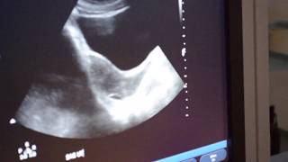 How to Perform Transabdominal Ultrasound [upl. by Liw]