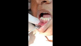 Epulis Removal A Dental Solution for a Healthier Smilequotsurgery [upl. by Laurance]