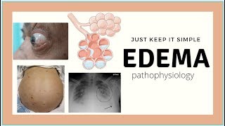 Edema Pathophysiology  Pulmonary edema Ascites physiology basics Med Madness [upl. by Ahsyla]