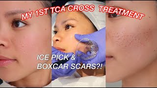 RF Fractional Microneedling Best with TCA CROSS amp Subcision for Synergistic Acne Scar Treatment [upl. by Ahseikram333]