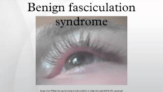 Benign fasciculation syndrome [upl. by Irahc]