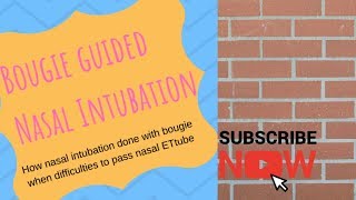 Bougie guided nasal intubation [upl. by Petulia617]