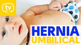 Hernia umbilical en los bebés [upl. by Janel806]