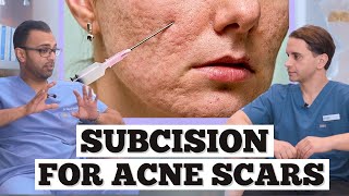 Subcision Acne Scars  Minor Surgery For Acne Scarring  Dr Somji amp Dr Solomon Explain Acne Scars [upl. by Odlaner]