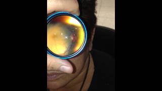 Inexpensive Telemedicine Fundoscopy performed using an Iphone and a 20D lens [upl. by Oremar11]