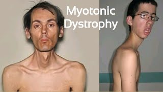 what is myotonic dystrophy Myotonic dystrophy Type 1 type 2  Symptoms Treatment [upl. by Ainslie383]