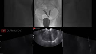 Bicornuate or Septate Uterus radiology ultrasound [upl. by Baumann453]