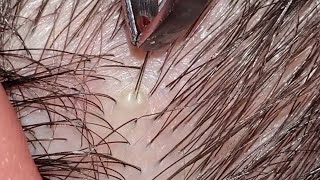 The Most Satisfying ingrown hair  Pulling Juicy Hair Part 44 [upl. by Godred]