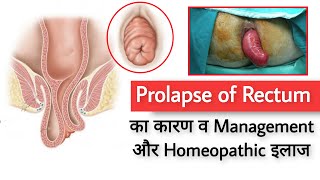 Prolapse of Rectum Causes Management and Homeopathic Treatment [upl. by Asiralc882]