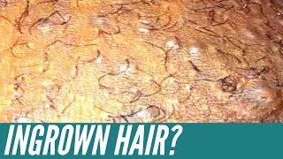 How to get rid of INGROWN HAIRS Expert tips that will get rid of them for good [upl. by Dearborn]