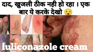 Luliconazole cream  Luliconazole cream 1 ww uses in hindi [upl. by Arimat]