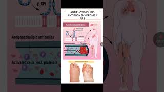 Antiphospholipid Antibody Syndrome [upl. by Hancock]