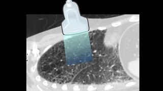 Lung Ultrasound  Interpretation Tutorial [upl. by Danczyk]