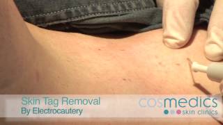 Skin Tag Removal by Laser  Surgery [upl. by Selena935]